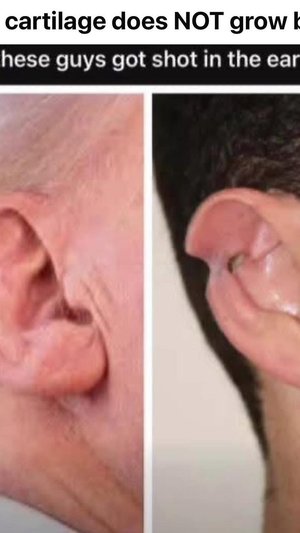showing that when you get shot in the ear, cartilage does not grow back. Trumps ear looks whole